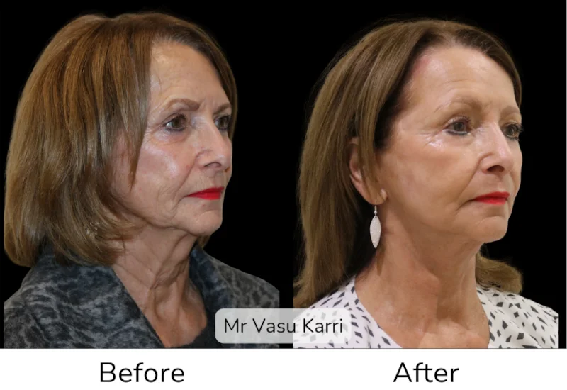 Facelift Patient 1 View 3